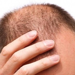 Oggi la calvizie si sconfigge all’estero