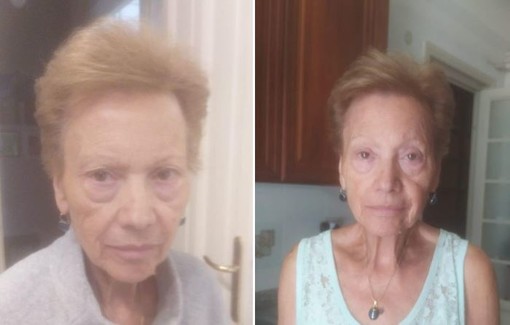 Ritrovata nella notte l'anziana malata di Alzheimer scomparsa da San Fruttuoso