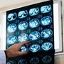 Nodulo polmonare: che cos’è, come si diagnostica e quando intervenire Nodulo polmonare: che cos’è, come si diagnostica e quando intervenire
