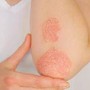 Giornata psoriasi, Ucb rinnova l'impegno contro lo stigma