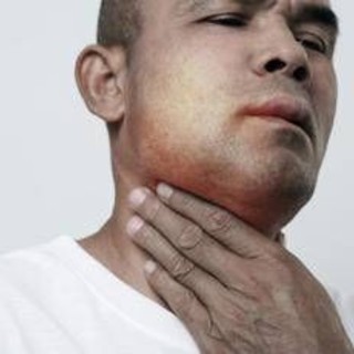 Angioedema ereditario, ok Ue a prima terapia preventiva mirata all'Rna