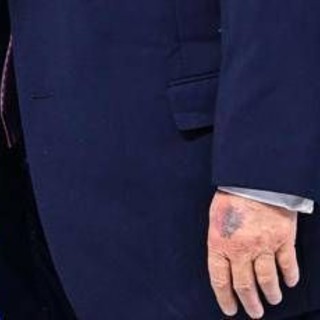 Trump e il nuovo livido sulla mano, tutte le ipotesi secondo Bassetti