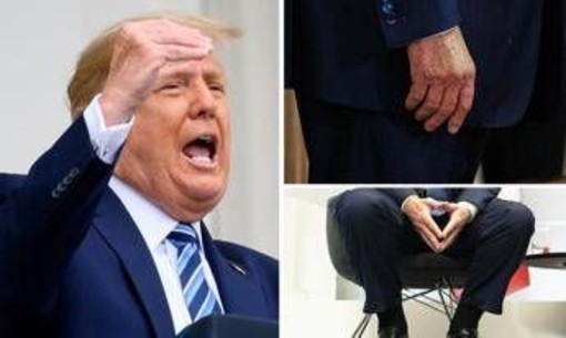 Trump e le gambe gonfie, cos'è l'insufficienza venosa cronica Trump e le gambe gonfie, cos'è l'insufficienza venosa cronica