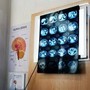 Di Battista, cosa indica un mal di testa forte e improvviso: le ipotesi del neurologo Di Battista, cosa indica un mal di testa forte e improvviso: le ipotesi del neurologo