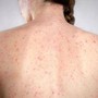 Morbillo, l'allarme dell'infettivologo Andreoni: "Casi in crescita, ricoveri frequenti negli adulti" Morbillo, l'allarme dell'infettivologo Andreoni: "Casi in crescita, ricoveri frequenti negli adulti"