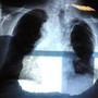 Cancro al polmone aggressivo, combinazione farmaci riduce del 58% rischio morte