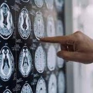 Stop tremori Parkinson senza bisturi, 10 pazienti curati con ultrasuoni a Napoli Stop tremori Parkinson senza bisturi, 10 pazienti curati con ultrasuoni a Napoli