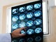 Nodulo polmonare: che cos’è, come si diagnostica e quando intervenire Nodulo polmonare: che cos’è, come si diagnostica e quando intervenire