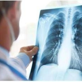 Cancro polmone Egfr-mutato, studio fase 3 Adaura: "Il 79% dei pazienti vivo a 8 anni con Osimertinib"