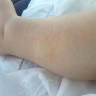Dermatite atopica, Aifa estende rimborso di upadacitinib dai 12 anni di età Dermatite atopica, Aifa estende rimborso di upadacitinib dai 12 anni di età