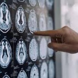 Centro Dbs Pavia, 100 interventi di neurostimolazione profonda per Parkinson Centro Dbs Pavia, 100 interventi di neurostimolazione profonda per Parkinson
