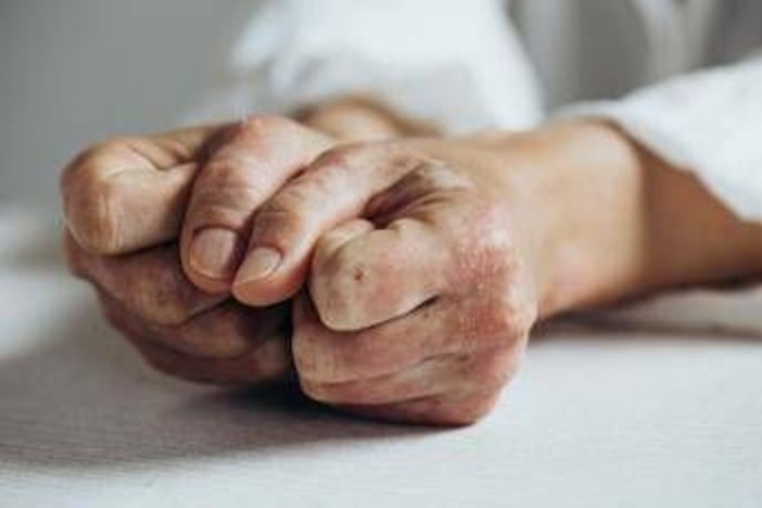 Lo studio, inibitore Il-23 riduce segni e sintomi artrite psoriasica attiva